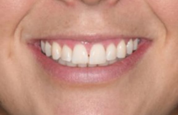 After view of esthetic crown lengthening showing enhanced smile proportions
