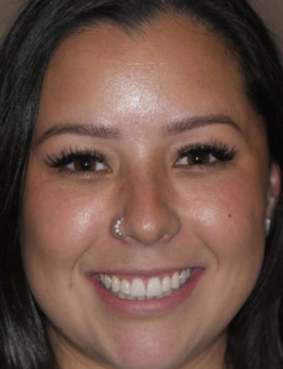 After esthetic crown lengthening showing improved smile balance and gum line symmetry