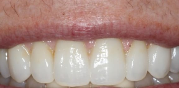 Close-up after gum grafting showing improved gum coverage and healthier tissue