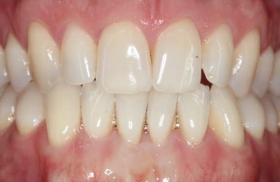 Close-up after gum grafting showing restored gum tissue and root coverage