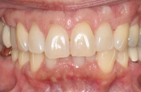 Close-up after gum grafting showing thicker, healthier gum tissue
