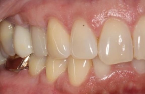 Alternate close-up after gum grafting showing improved gum coverage and tissue stability