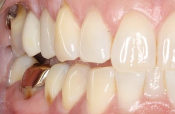 Alternate close-up before gum grafting showing exposed tooth roots due to gum recession
