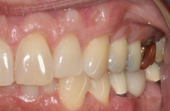 Additional close-up after gum grafting demonstrating enhanced gum contour and coverage