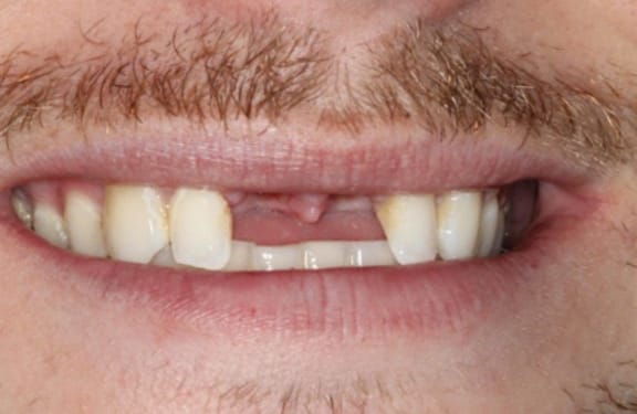 Before view of dental implant case with two missing front teeth prior to treatment